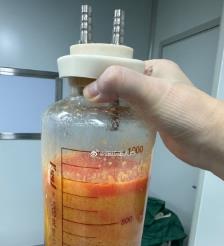 随县水动力吸脂手术要做多久？